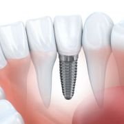Biocompatibility of Titanium bar